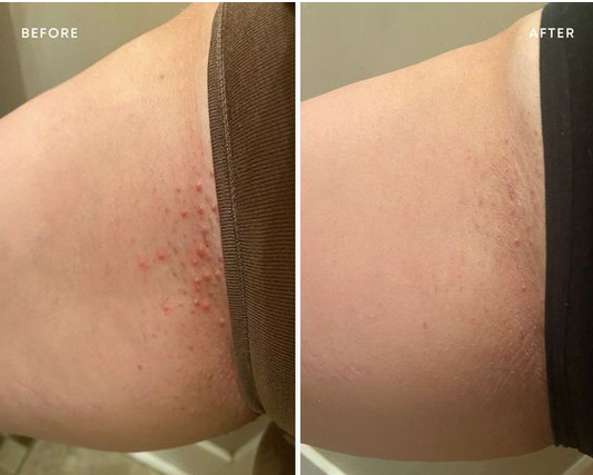 Bumps Control Shaving Cream For Sensitive, Dry to Normal Skin